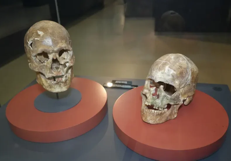 ** Five thousand year old human skull showing healed surgical incision from successful ancient brain operation