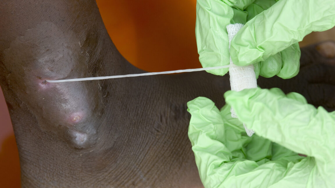 Guinea Worm Near Eradication: Only 10 Cases in 2025