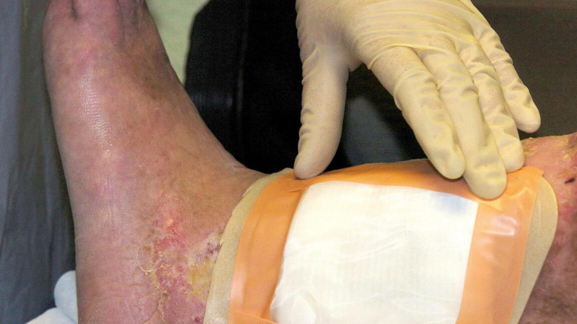 FDA Clears Second Maggot Species for Wound Healing