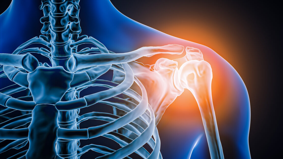 X-ray showing construction worker's destroyed shoulder joint with floating arm bone beside swollen shoulder photo