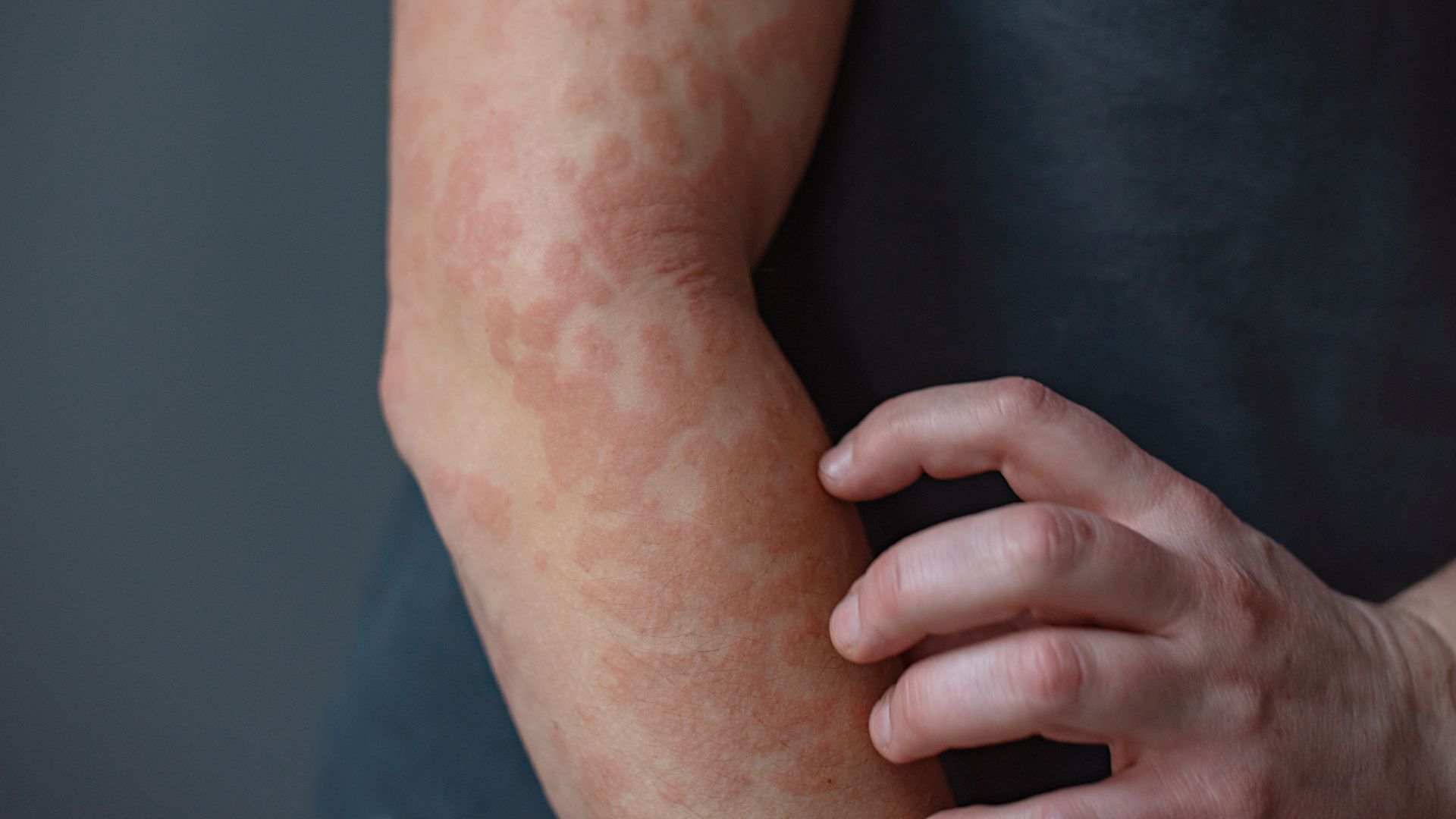 Keratin Discovery Opens Door to New Skin Disease Treatments
