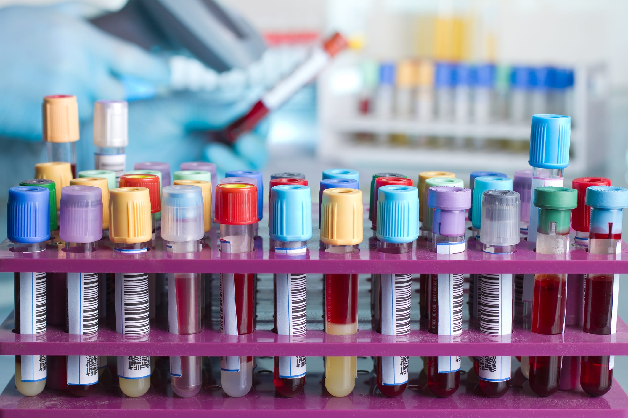 Medical laboratory technician analyzing blood sample for circulating tumor DNA detection