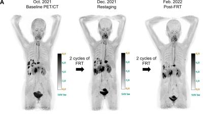 Medical scan showing tumor response in pancreatic cancer patient receiving FAP-targeted radiopharmaceutical therapy