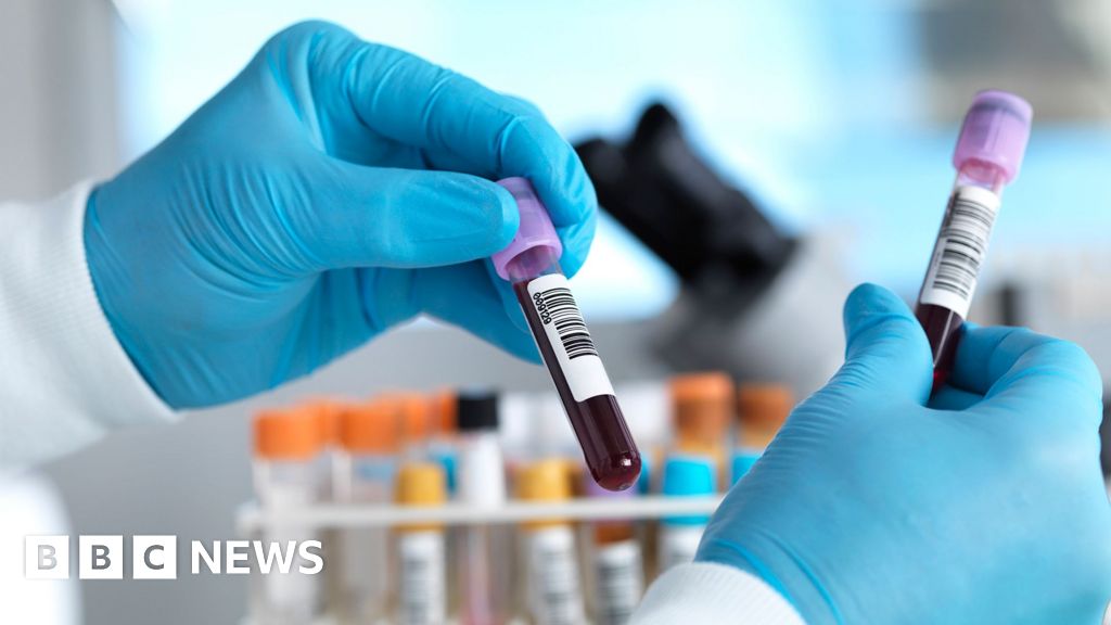 England on Track to Eliminate Hepatitis C by 2030