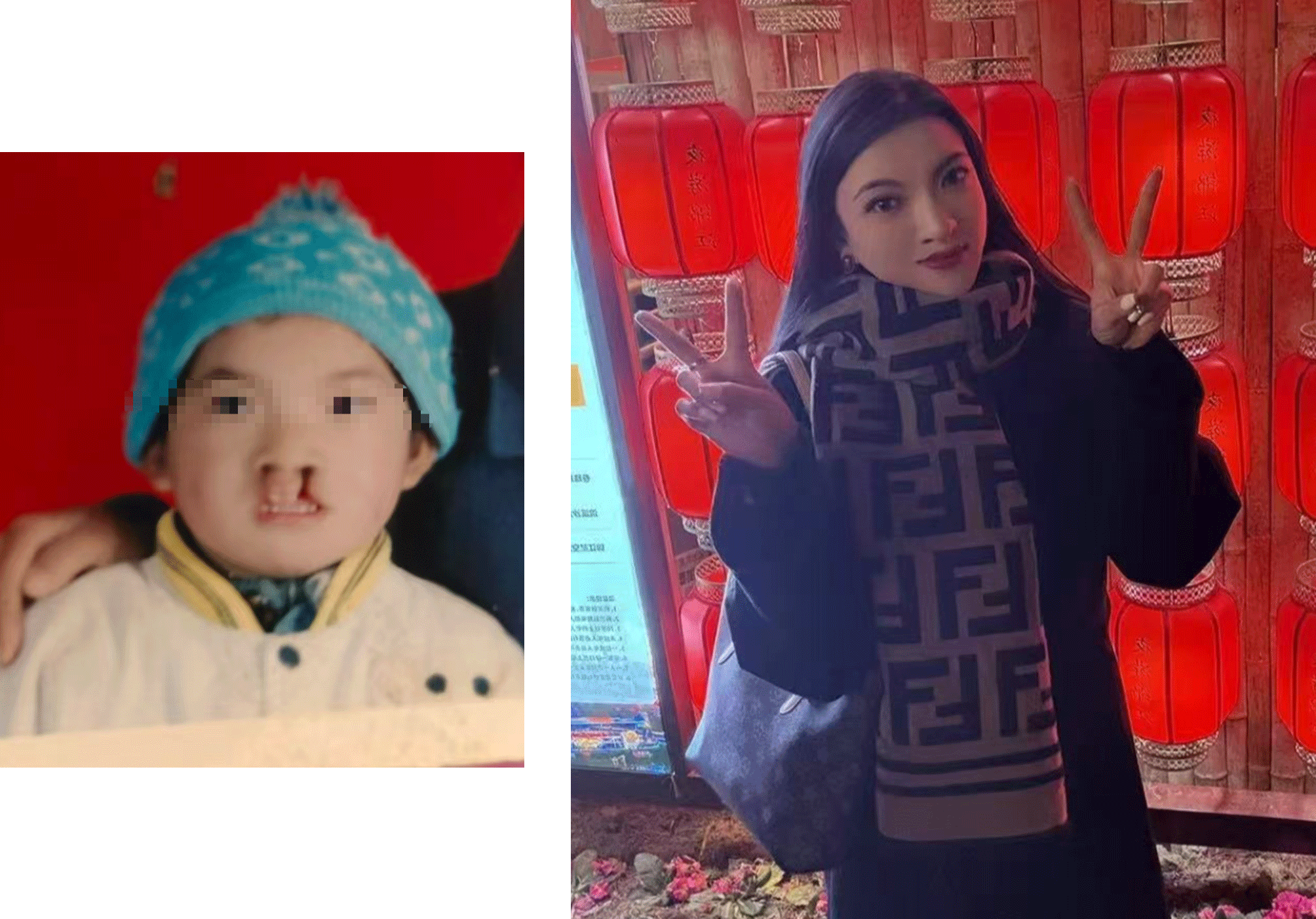 Beijing Hospital Performs 11,000 Free Cleft Surgeries - Image 3