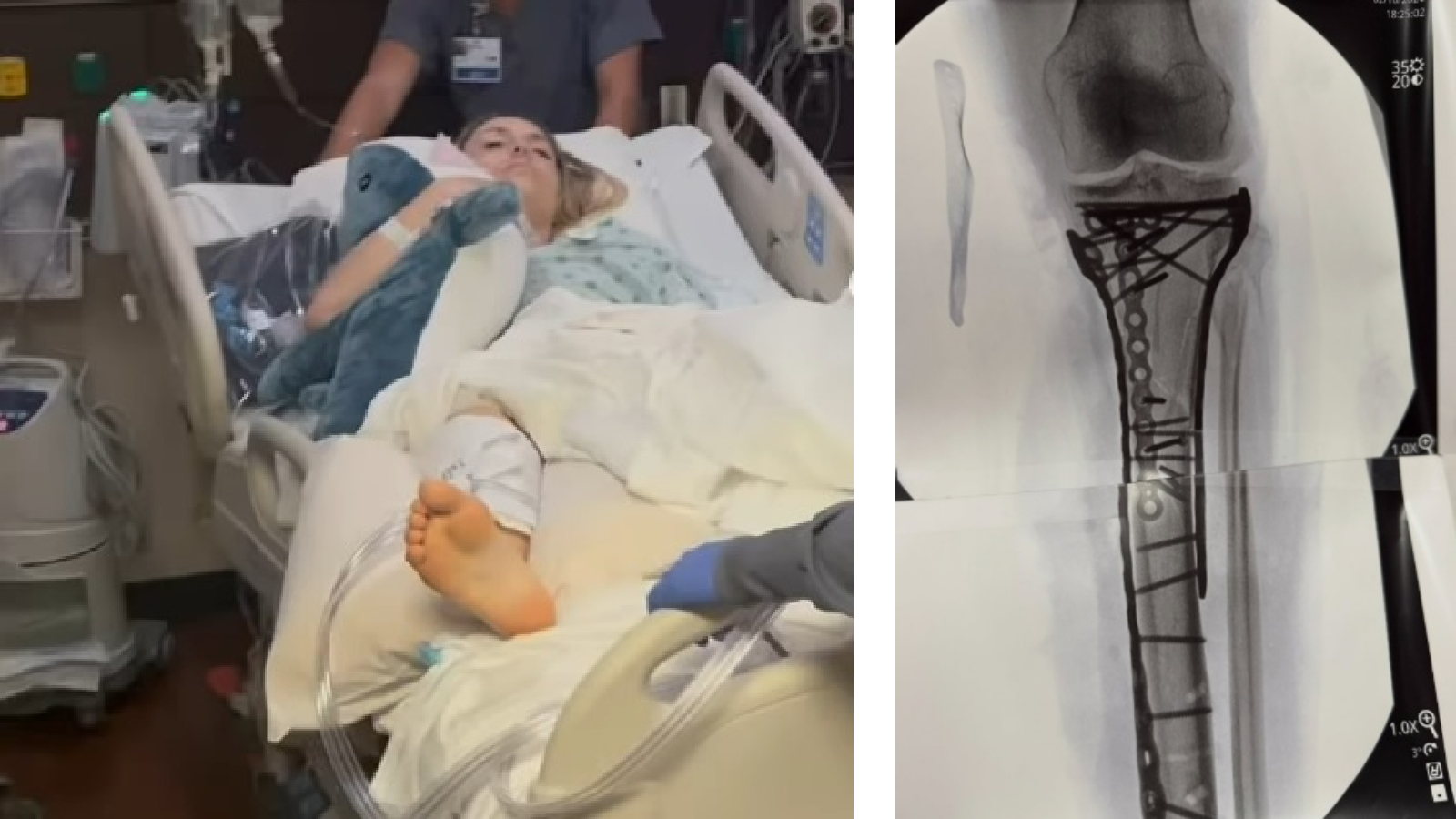 Lindsey Vonn's Leg Saved After Olympic Crash Complications