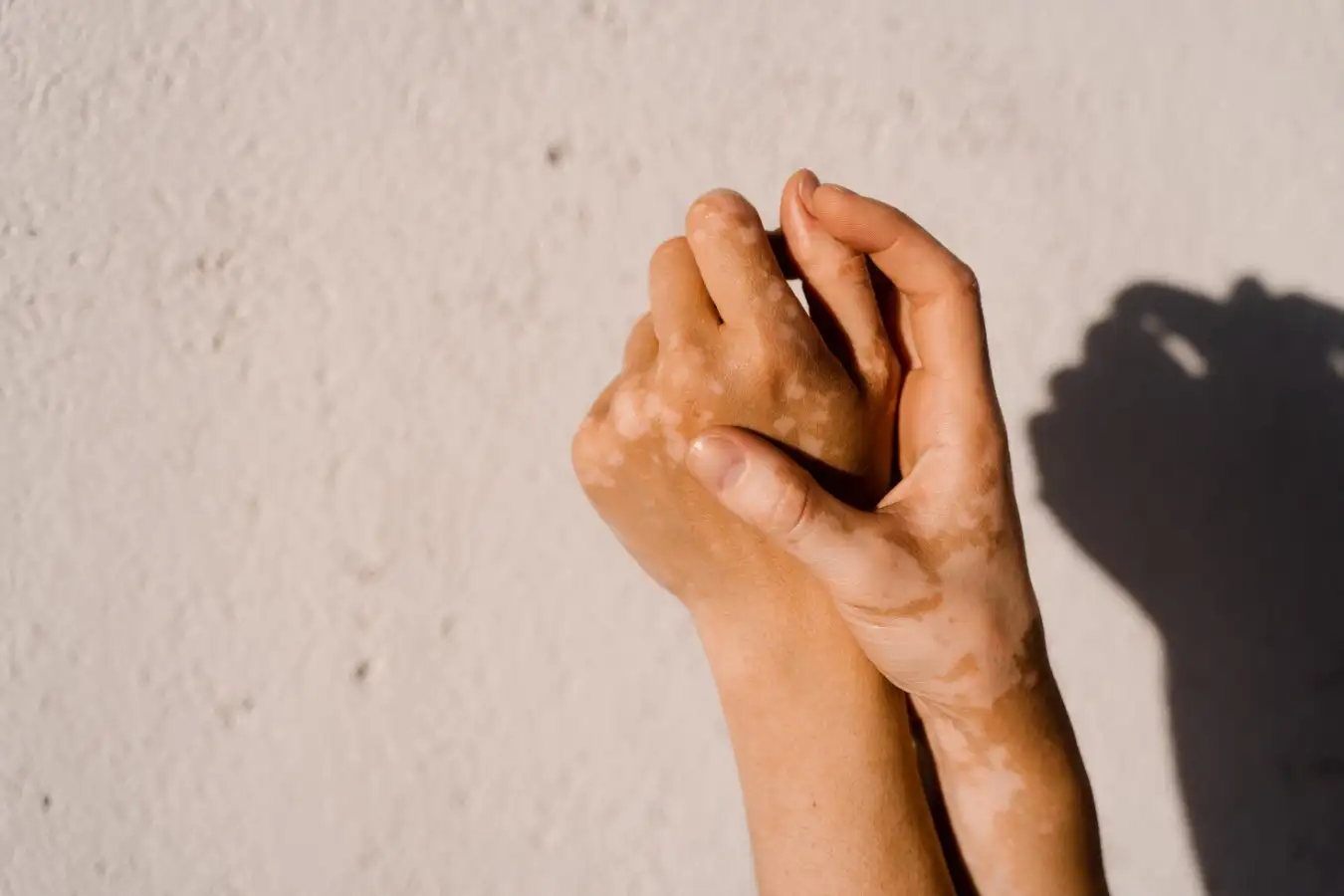 First Vitiligo Cream Now Free on England's NHS