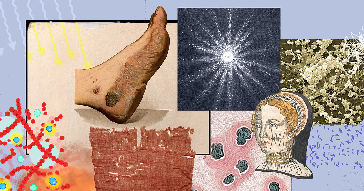 Light-Activated Gels Heal Stubborn Wounds in 95% of Cases
