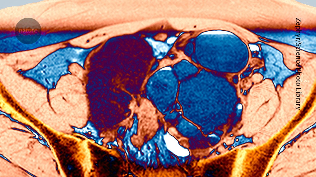 New Drug Shows Promise for 190M with Endometriosis