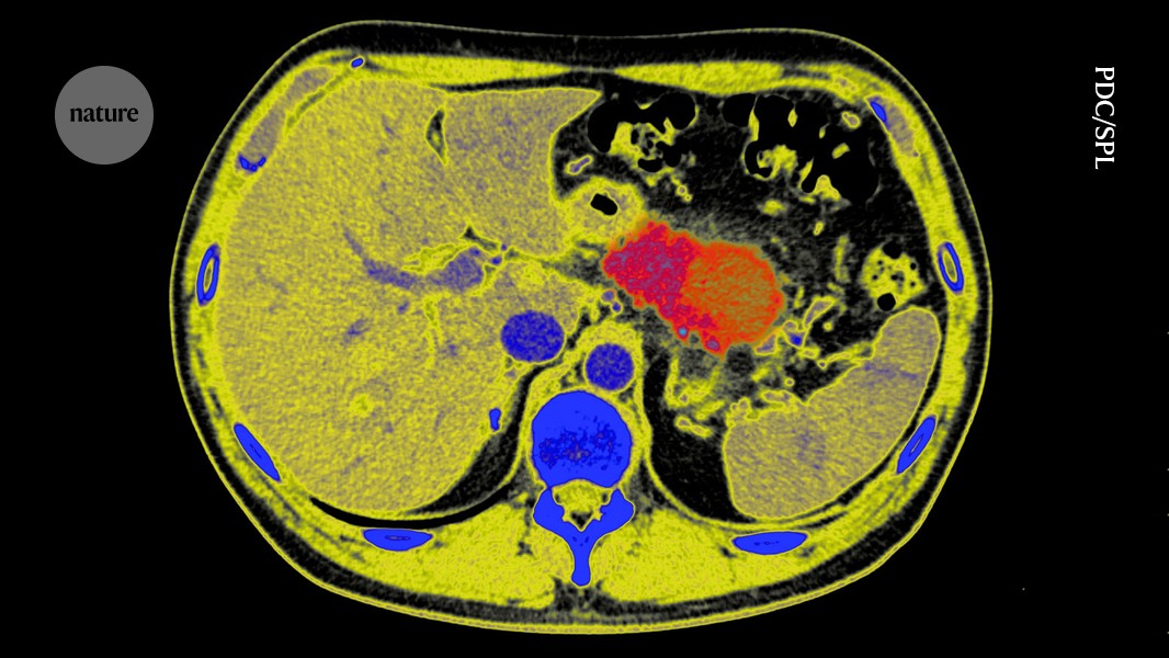 New Drug Sparks Hope for Pancreatic Cancer Survival