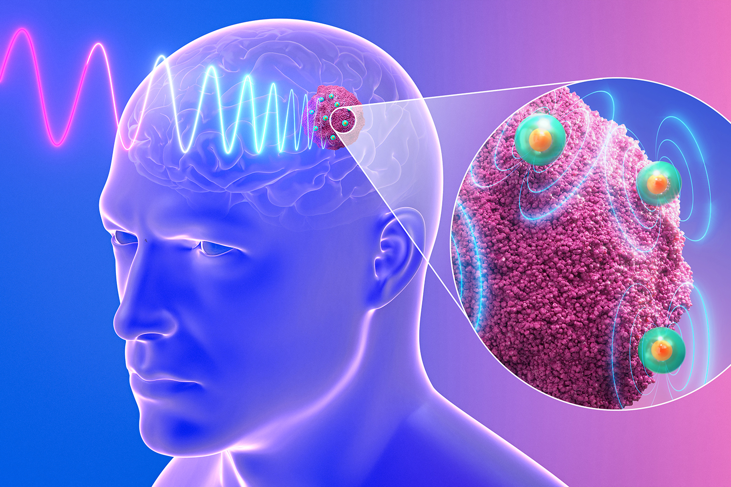 MIT's Tiny Nanoantennas Kill Brain Cancer Without Surgery