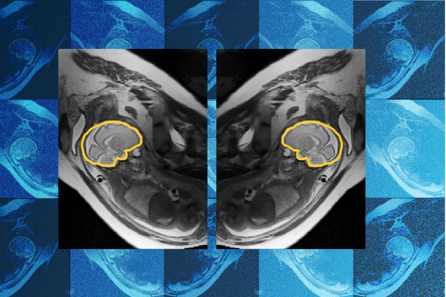 MIT Creates AI That Tracks Moving Babies During Brain Scans