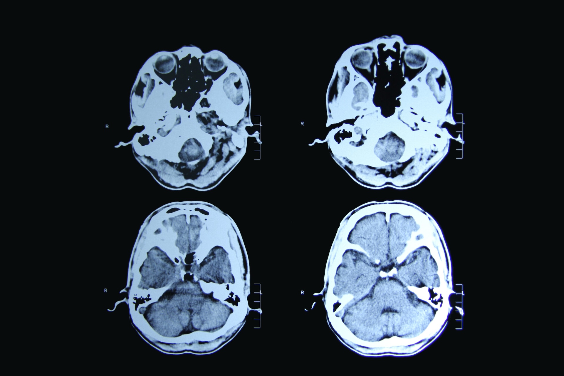 UBC Scientists Find Why Huntington's Starts 10 Years Early