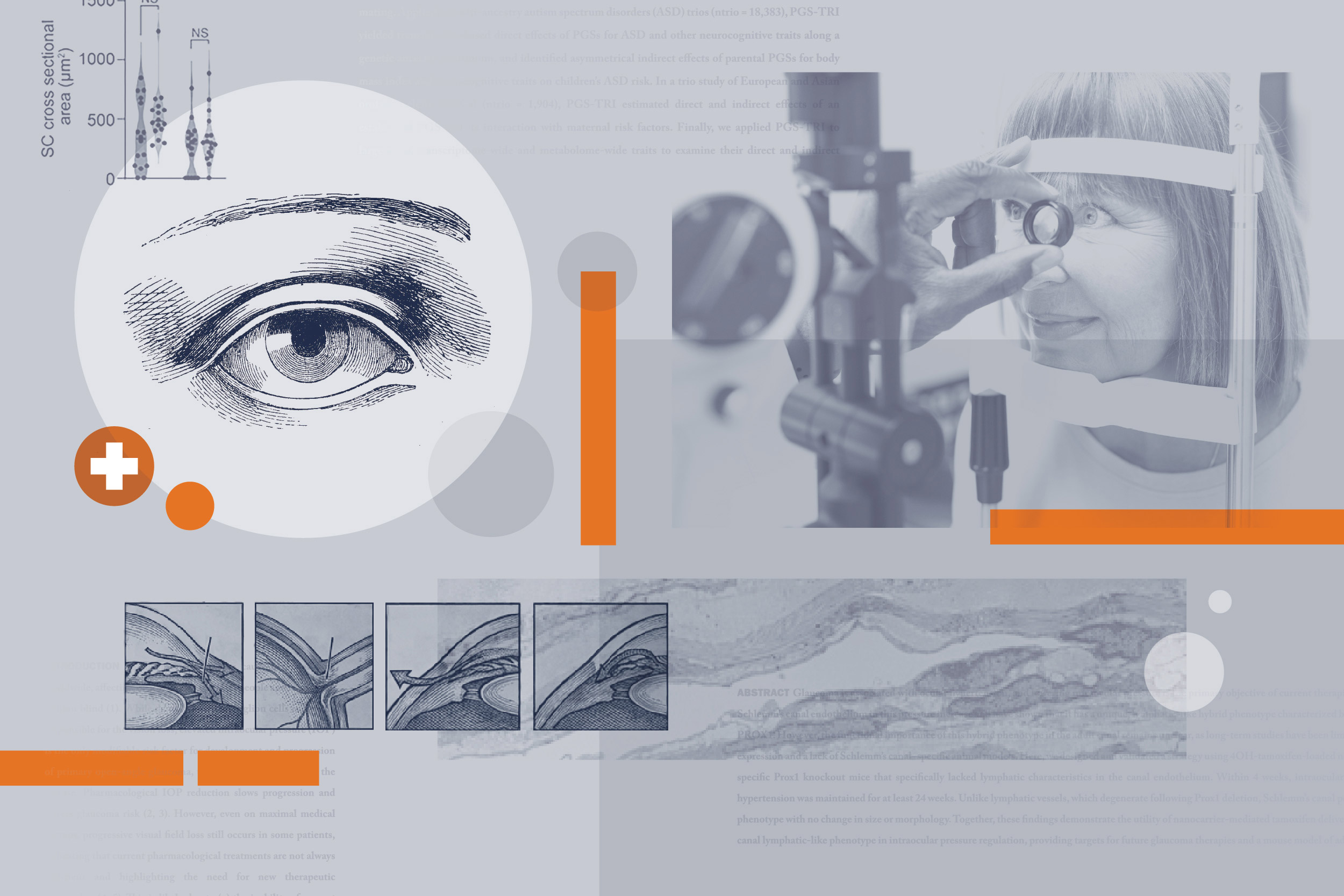 Illustration showing tiny therapeutic particles draining fluid from human eye to reduce glaucoma pressure