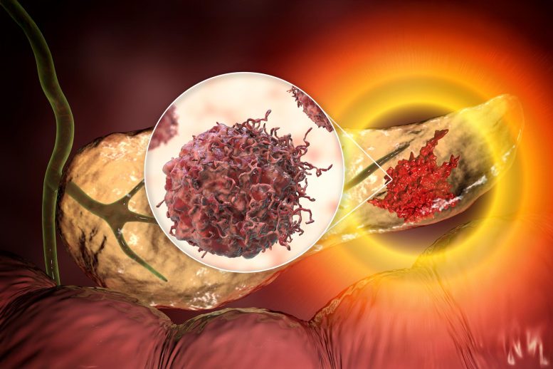 AI Spots Pancreatic Cancer 16 Months Before Diagnosis - Image 2