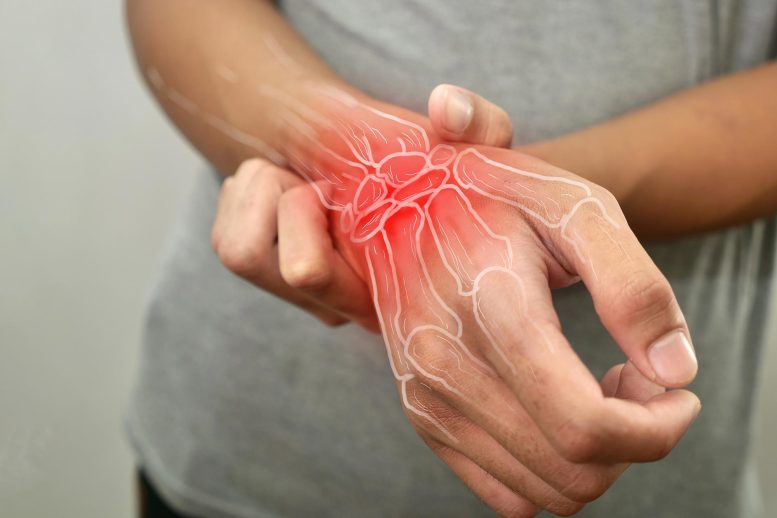 Scientists Find Way to Stop Psoriasis Joint Disease Early - Image 2