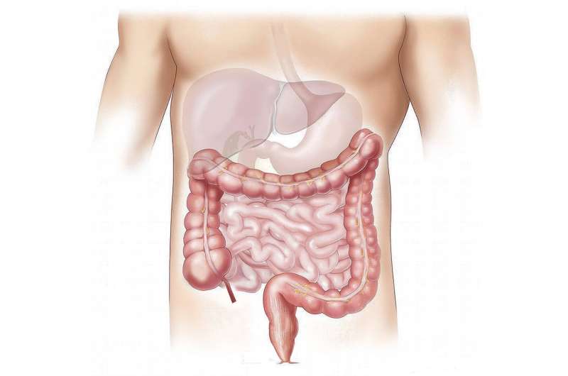 UK Study Reveals How to Catch IBD Cancer Earlier - Image 3