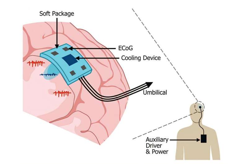 3D-Printed Brain Implant Offers New Hope for Epilepsy - Image 2