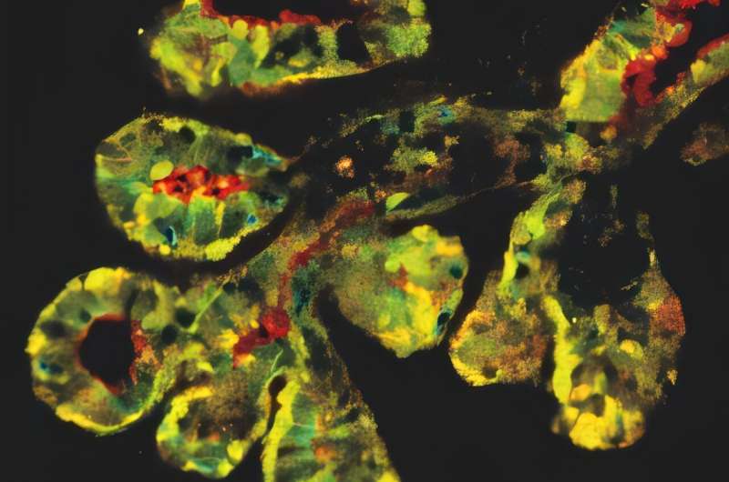 Garvan Team Finds Key to Smarter Breast Cancer Care - Image 2