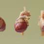 Heart Surgery Study: Off-Pump Method Saves More Lives - Image 3