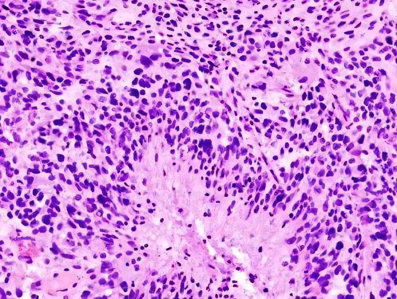 Microscope view of glioblastoma brain tumor cells being targeted by therapeutic treatment