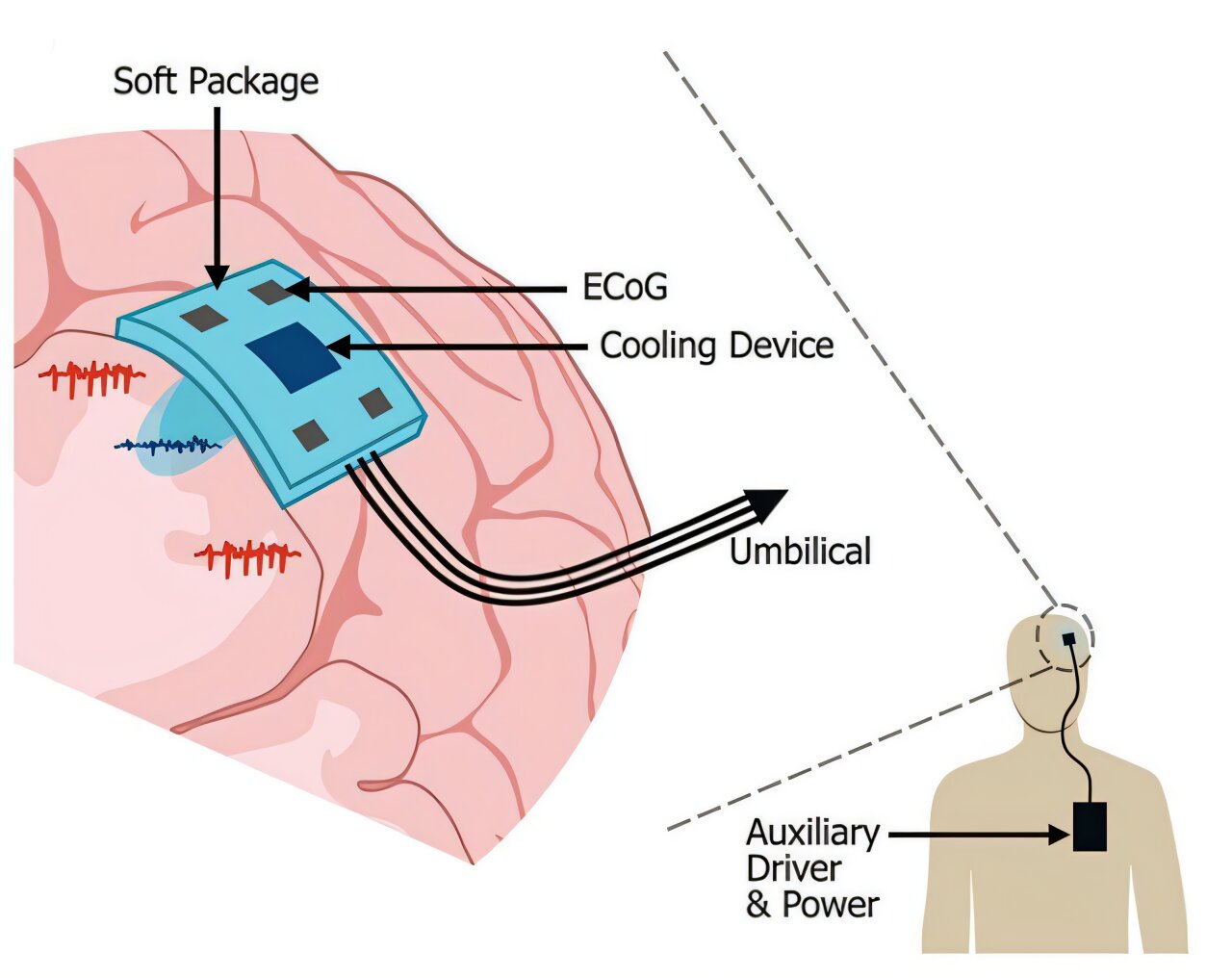 3D-Printed Brain Implant Offers New Hope for Epilepsy