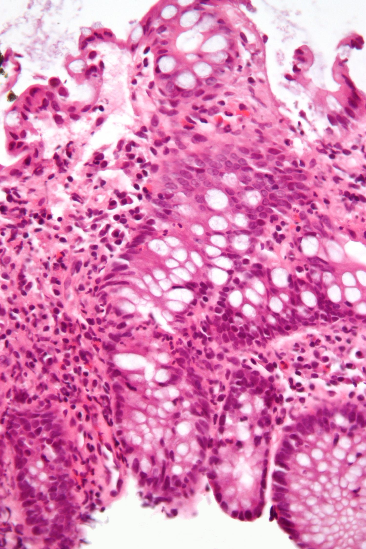 Microscope view showing inflammation in colon tissue affected by inflammatory bowel disease