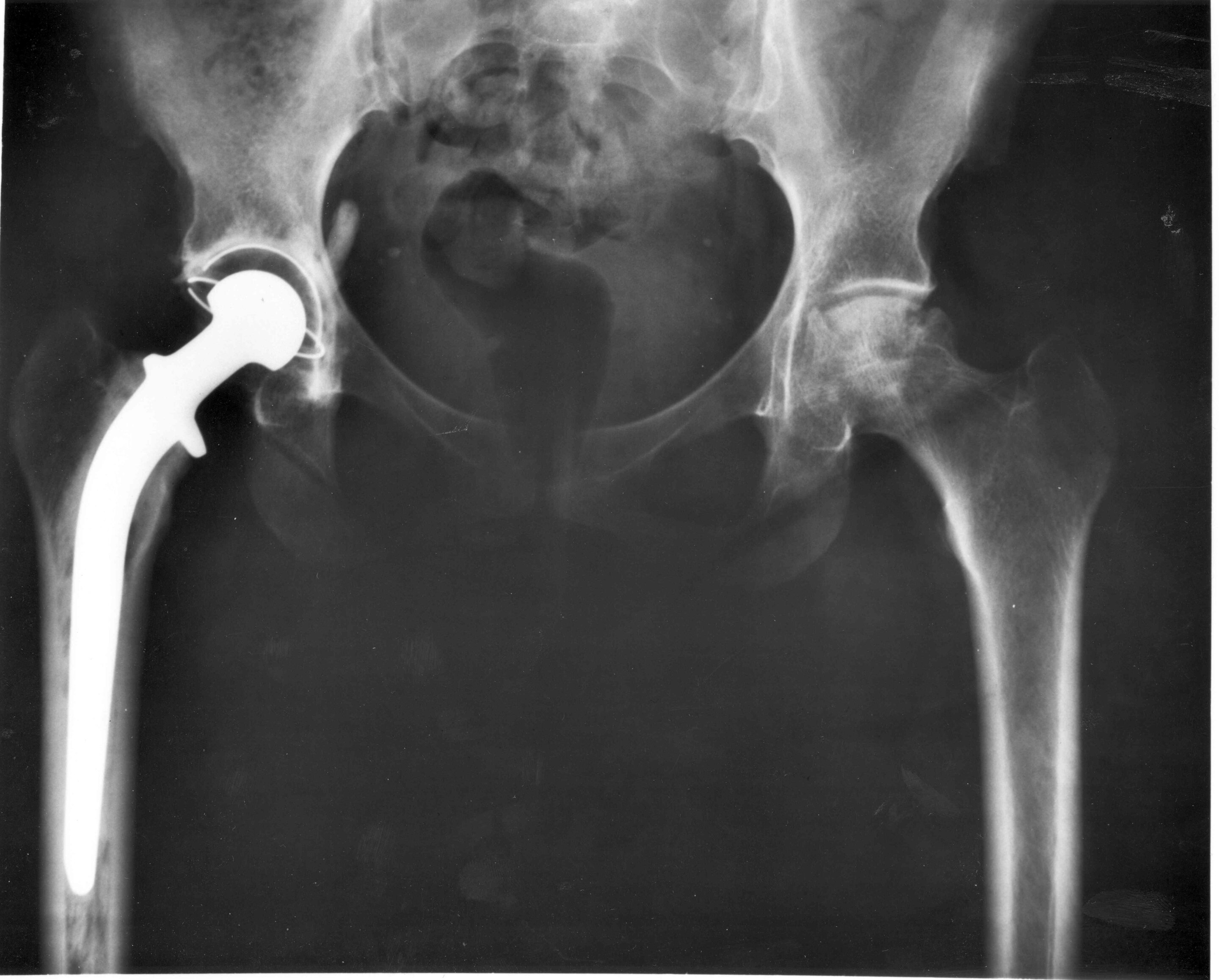 Modern Hip Replacements Last 25+ Years, Study Finds