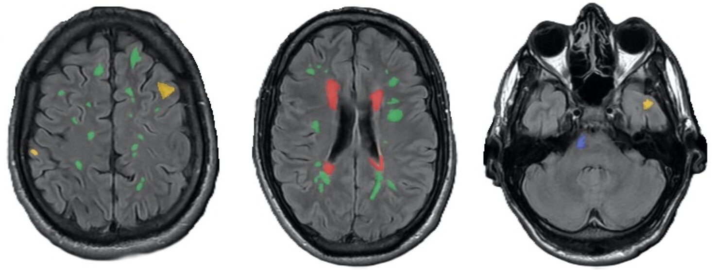 AI Spots Hidden Epilepsy Signs Doctors Miss on Brain Scans