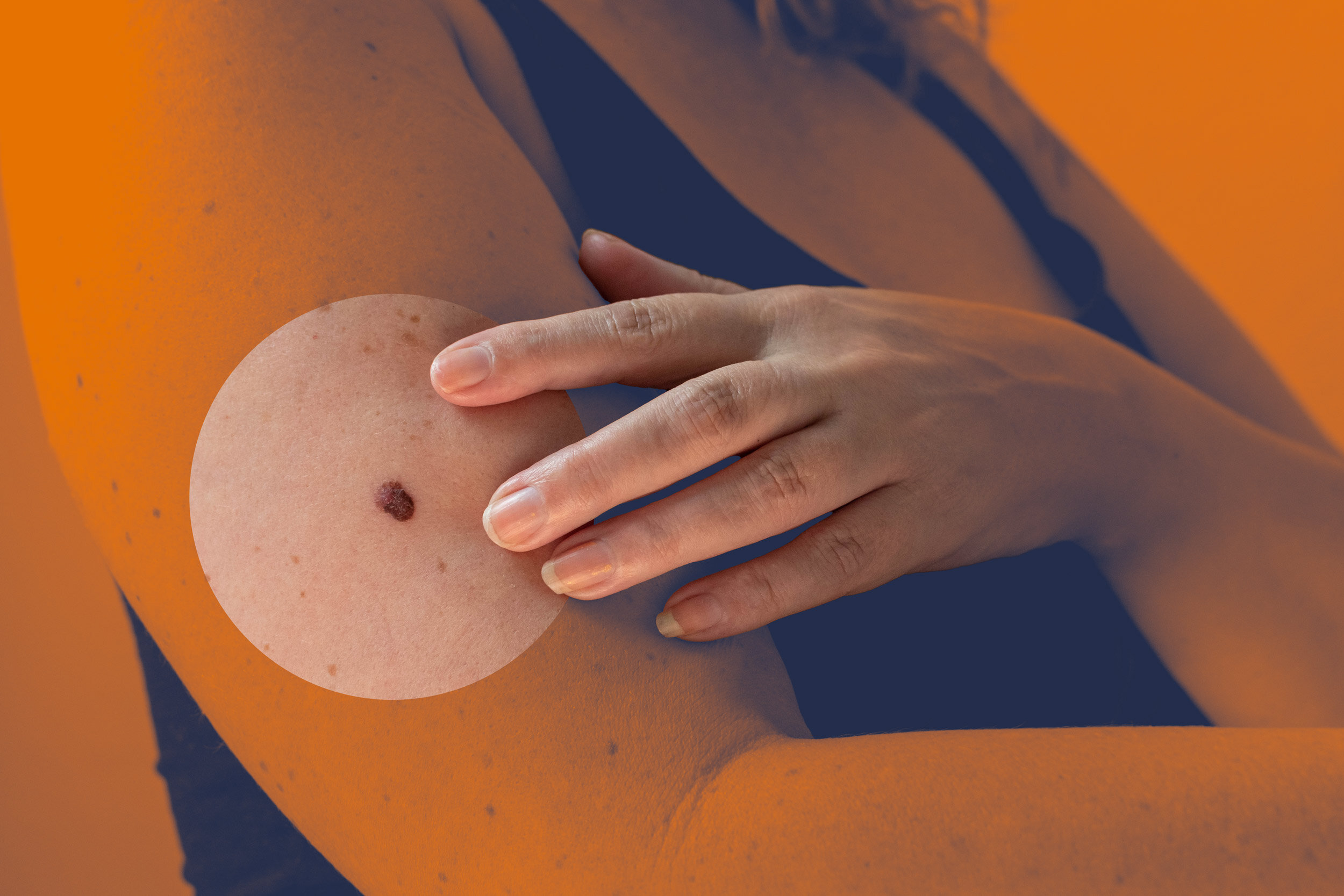Melanoma Vaccine Cuts Cancer Return Risk by 42%