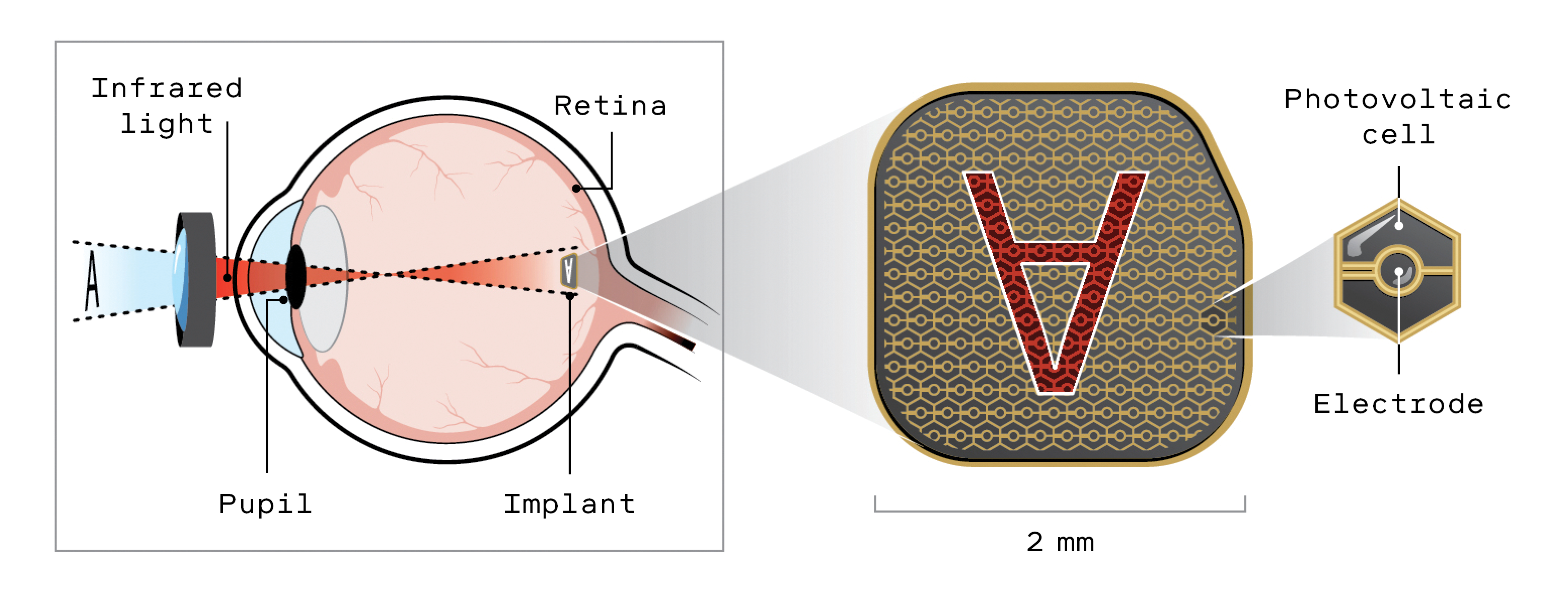 New Implant Restores Sight for 5 Million AMD Patients - Image 4