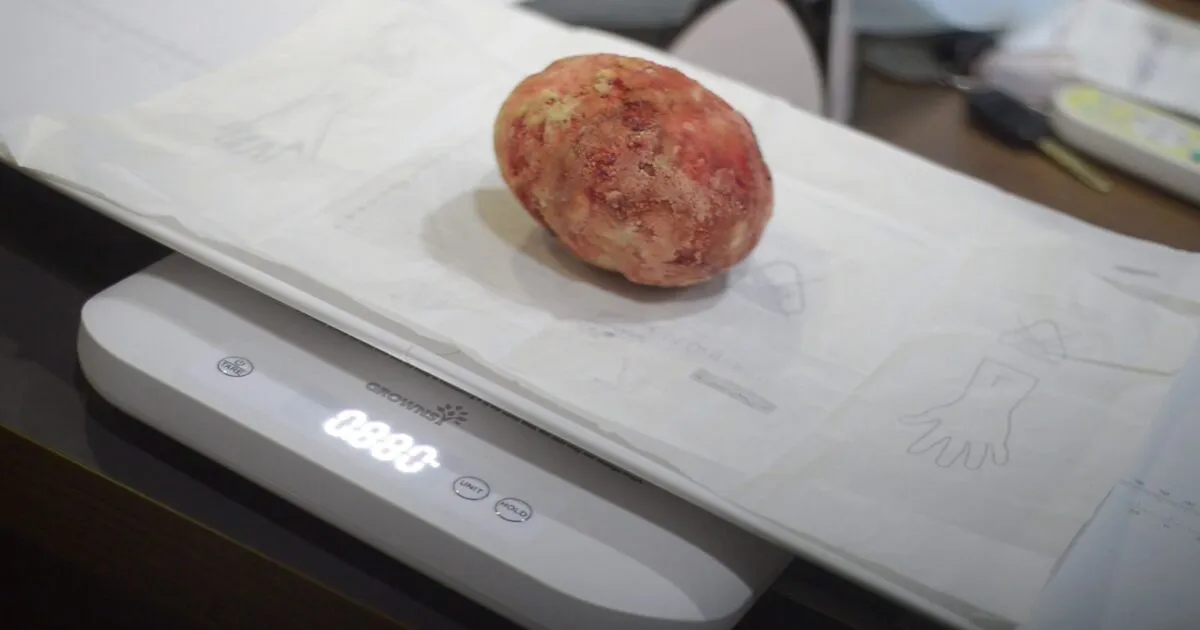 Ghana Doctors Remove 2-Pound Bladder Stone After 30 Years