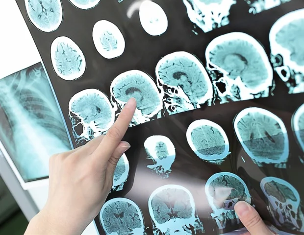 New Stroke Drug Helps 69% Recover With Little Disability