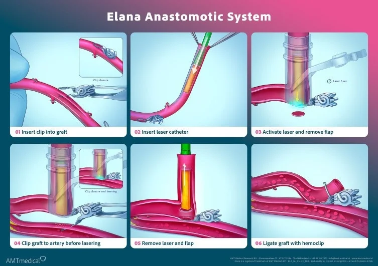 New Heart Bypass Tech Ends 60 Years of Hand-Sewn Surgery