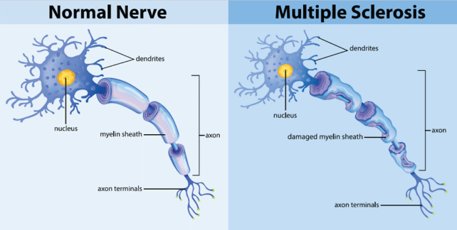 Scientists Find How Common Virus May Trigger MS - Image 3