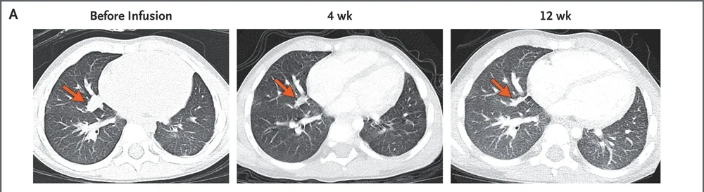 3-Year-Old's Liver Cancer Vanishes After New Treatment - Image 3