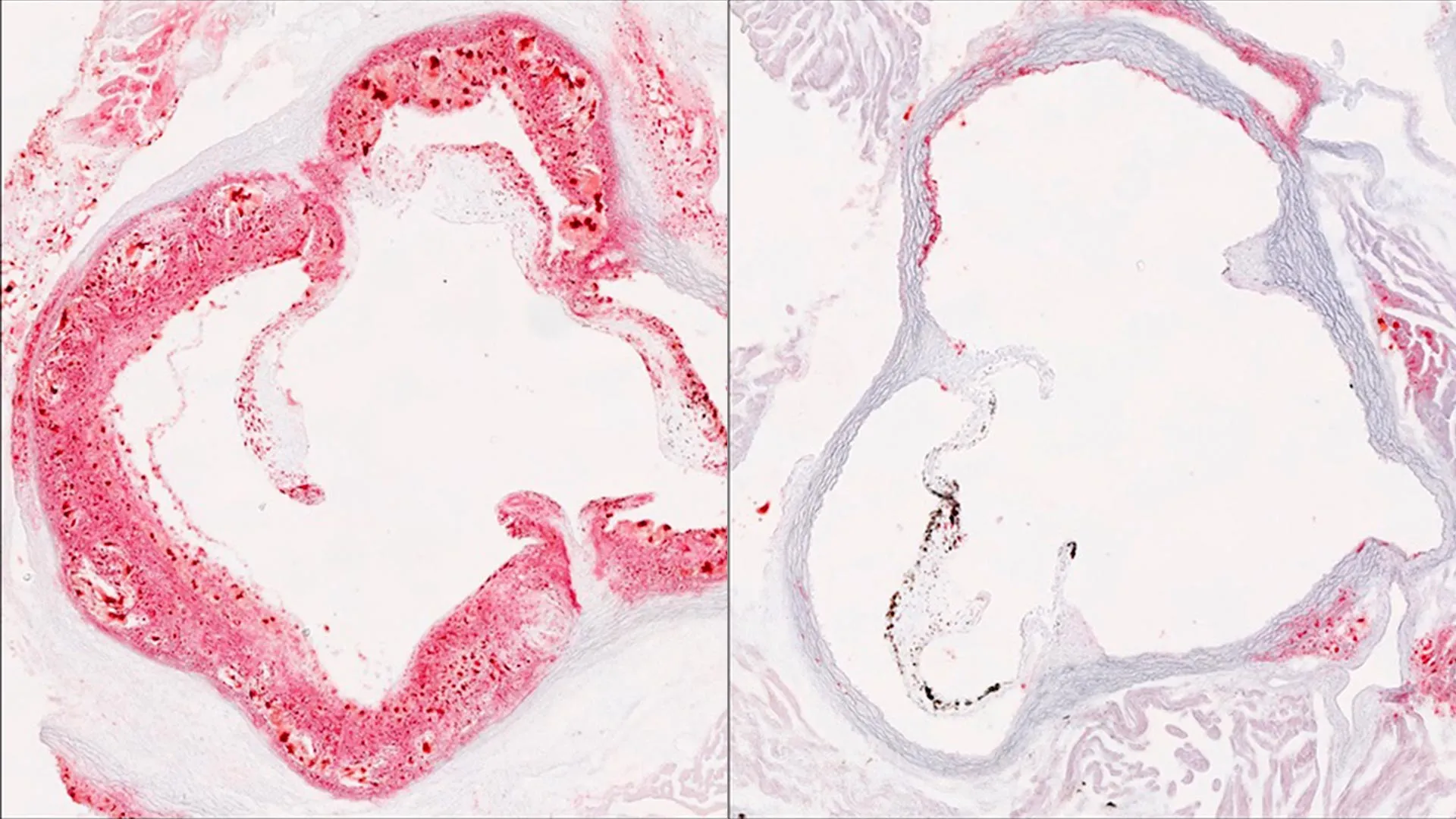 Scientists Find Liver Protein That Cuts Bad Cholesterol