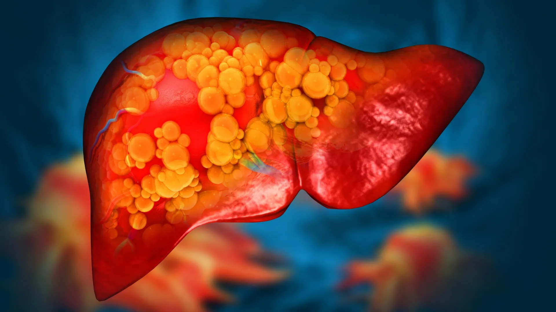 New Drug Reverses Severe Fatty Liver Disease in Primates