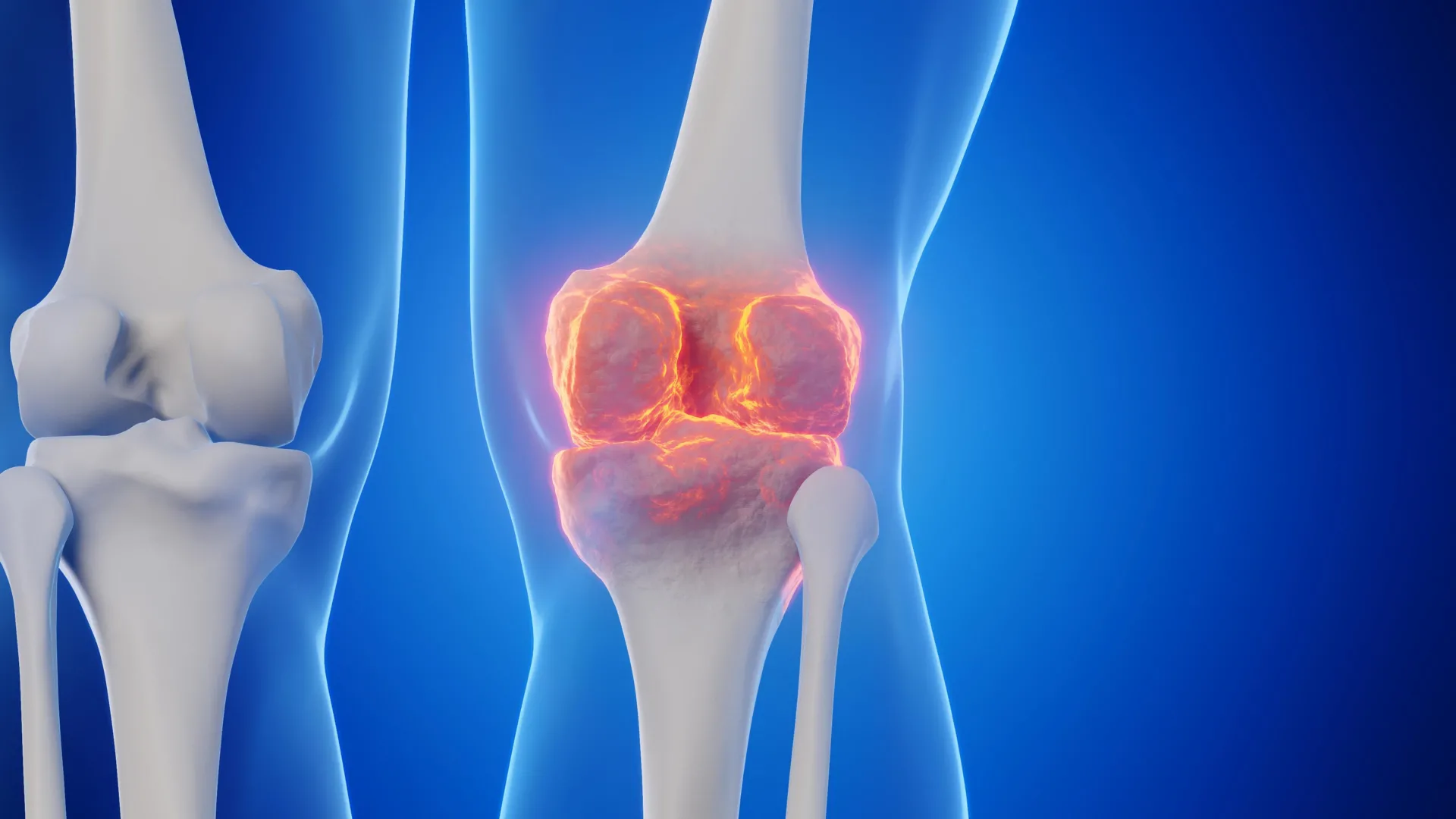 Stanford Scientists Regrow Knee Cartilage in Breakthrough