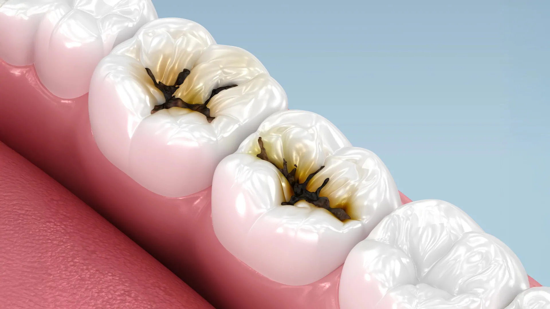Liquid Stops Cavities in Kids Without Drilling or Pain