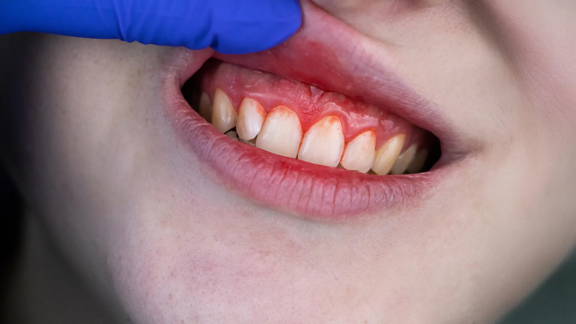 Omega-3 and Aspirin Match Antibiotics for Gum Disease