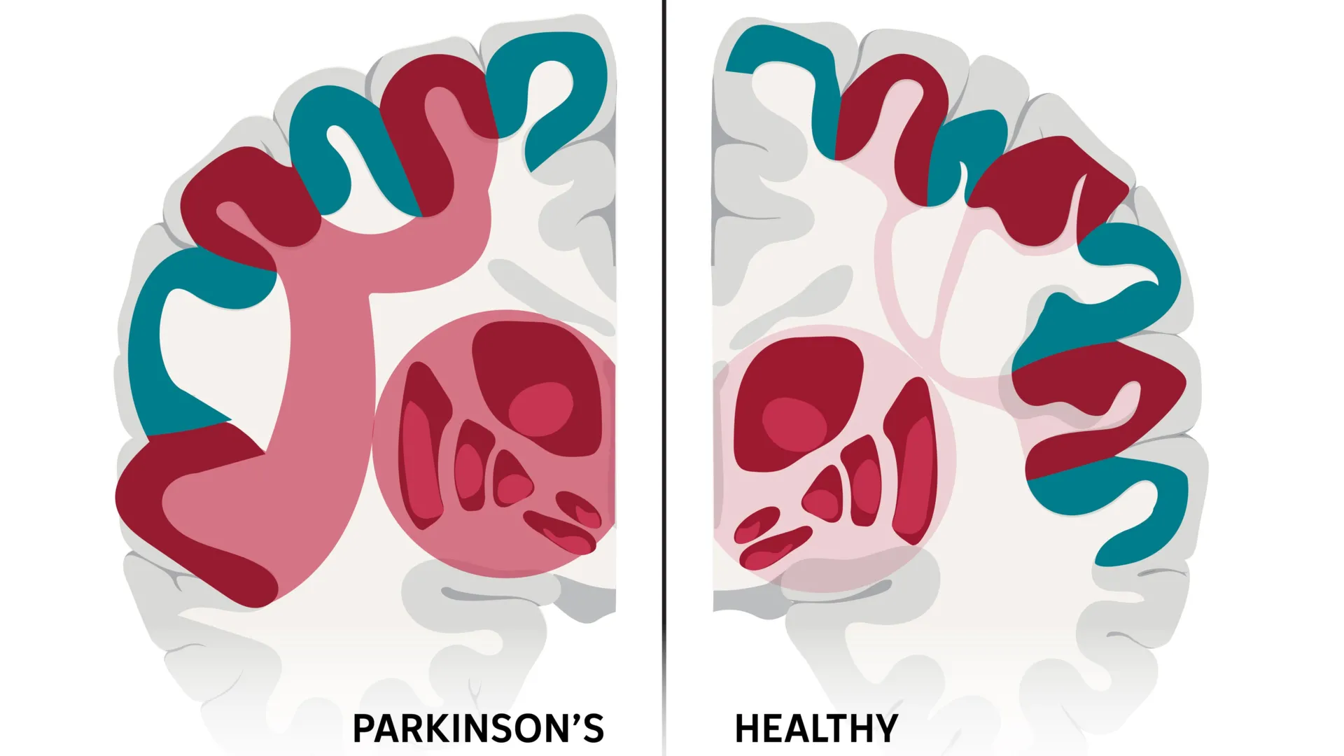 Colorful brain illustration showing connected neural networks highlighting the SCAN region associated with Parkinson's disease