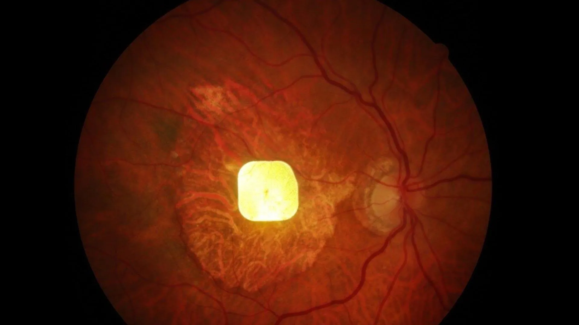 Tiny Eye Implant Helps 81% of Blind Patients Read Again