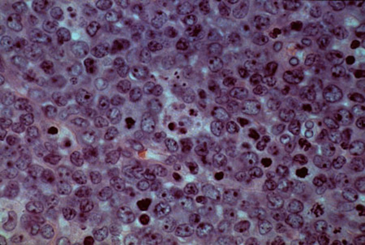 New Cancer Treatment Triples Cell Elimination in Lymphoma