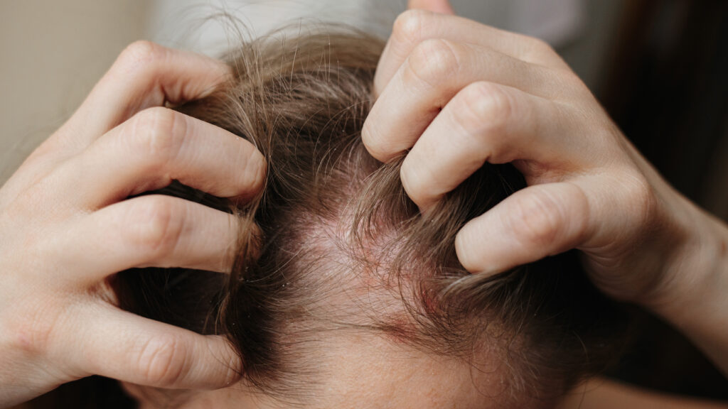 New Psoriasis Drug Shows 63% Complete Skin Clearance