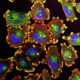 Cancer Vaccine Shows Major Success in Melanoma Patients - Image 4