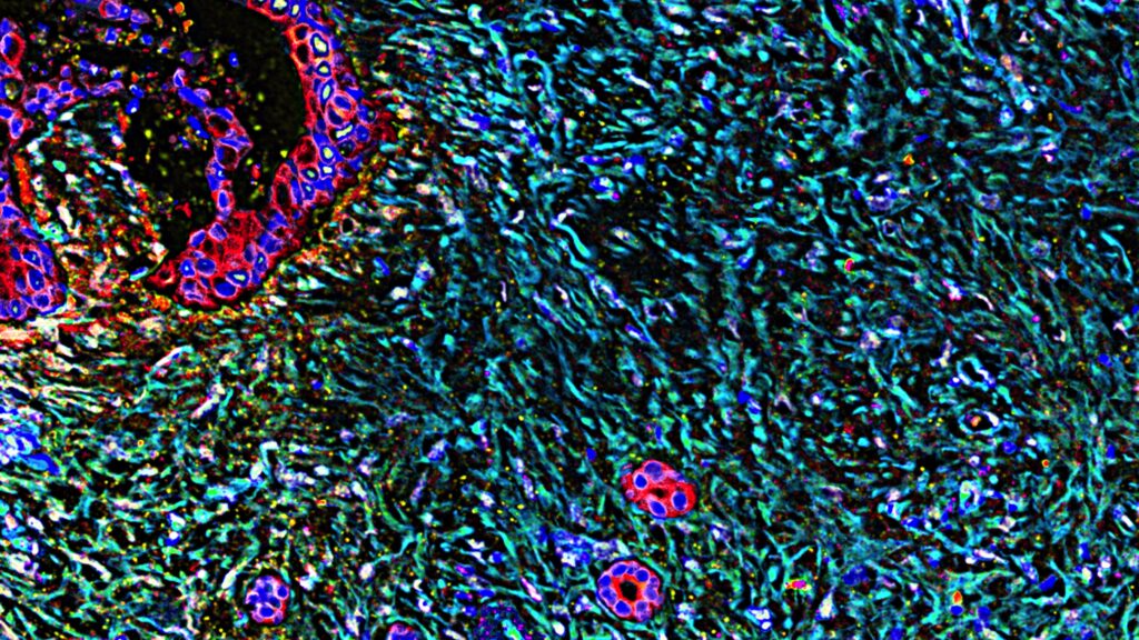 Microscopic view of red cancer cells showing targeted treatment potential for patients