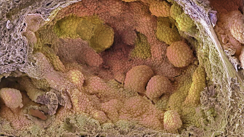 New Hormone Therapy Boosts Prostate Cancer Surgery Outcomes