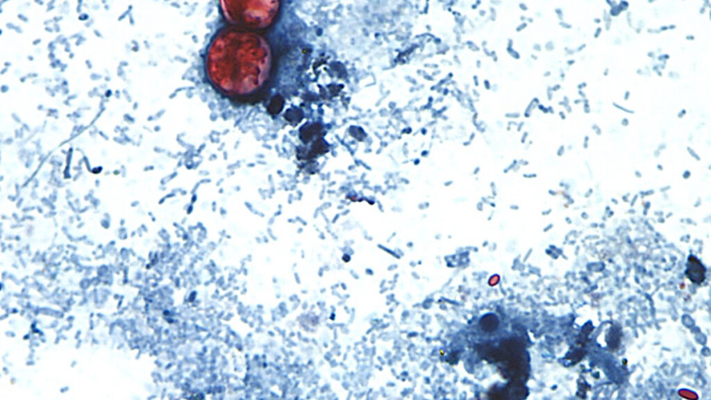 U.S. Declares End to Largest Cyclospora Outbreak