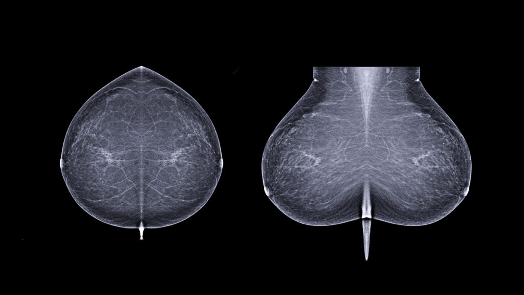 Everlywell Brings AI Breast Cancer Screening Home